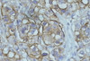 45-938 (0.5ug/ml) staining of paraffin embedded Human hepatocelluar carcinoma. Data obtained from C. Furer, Visceral Surgery, University of Bern, Switzerland.