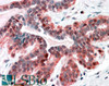 46-397 (3.8ug/ml) staining of paraffin embedded Human Breast Steamed antigen retrieval with citrate buffer pH 6, AP-staining.