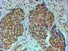 46-493 (4ug/ml) staining of paraffin embedded Human Breast cancer. Steamed antigen retrieval with citrate buffer pH 6, HRP-staining.