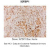 Antibody used in IHC on Human lung carcinoma at 1:300.