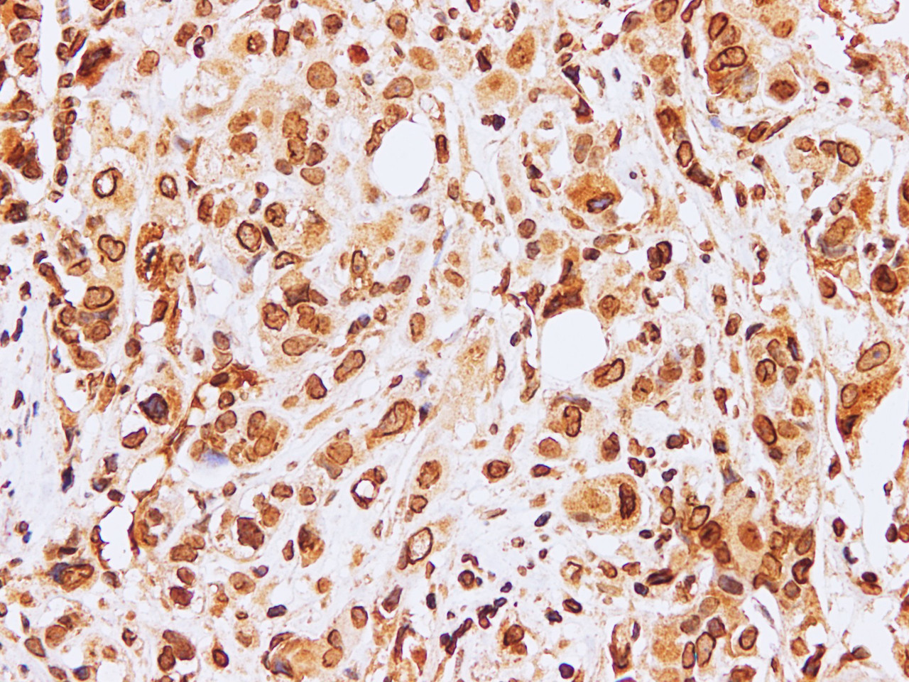 Immunohistochemistry of paraffin-embedded Human breast cancer using Lamin B1 Polyclonal Antibody at dilution of 1:100
