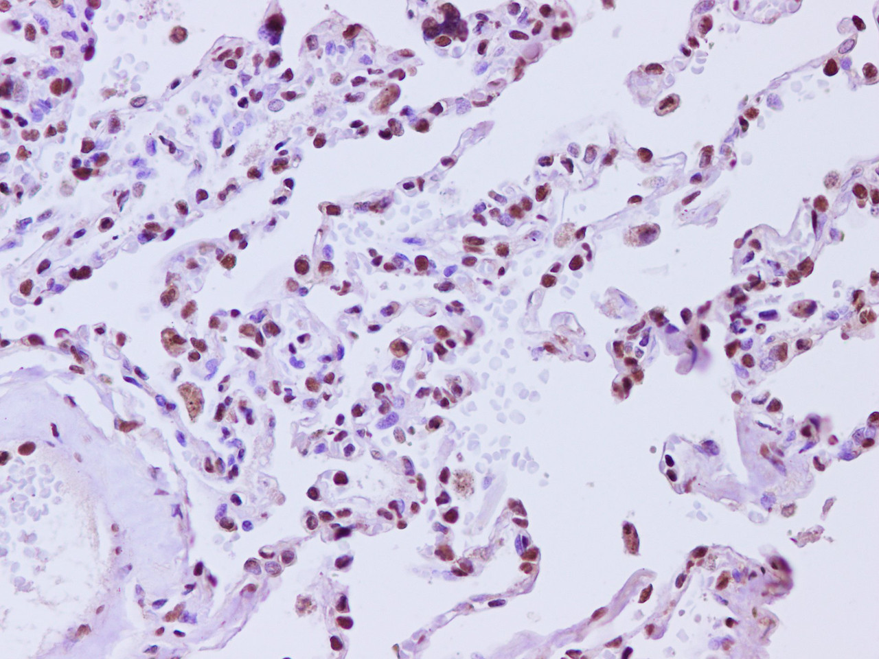 Immunohistochemistry of paraffin-embedded Human lung tissue using HMGB2 Polyclonal Antibody at dilution of 1:200