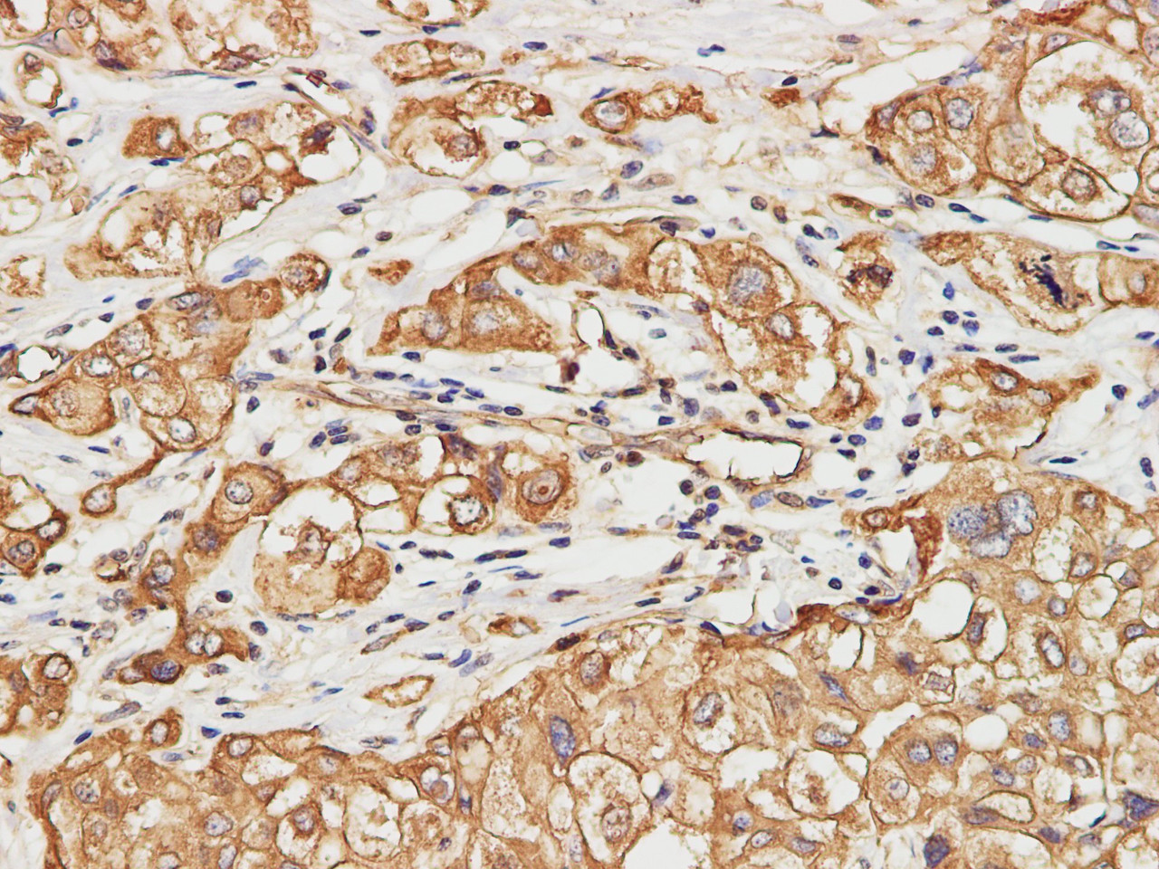 Immunohistochemistry of paraffin-embedded Human liver cancer using CK-8 Polyclonal Antibody at dilution of 1:200