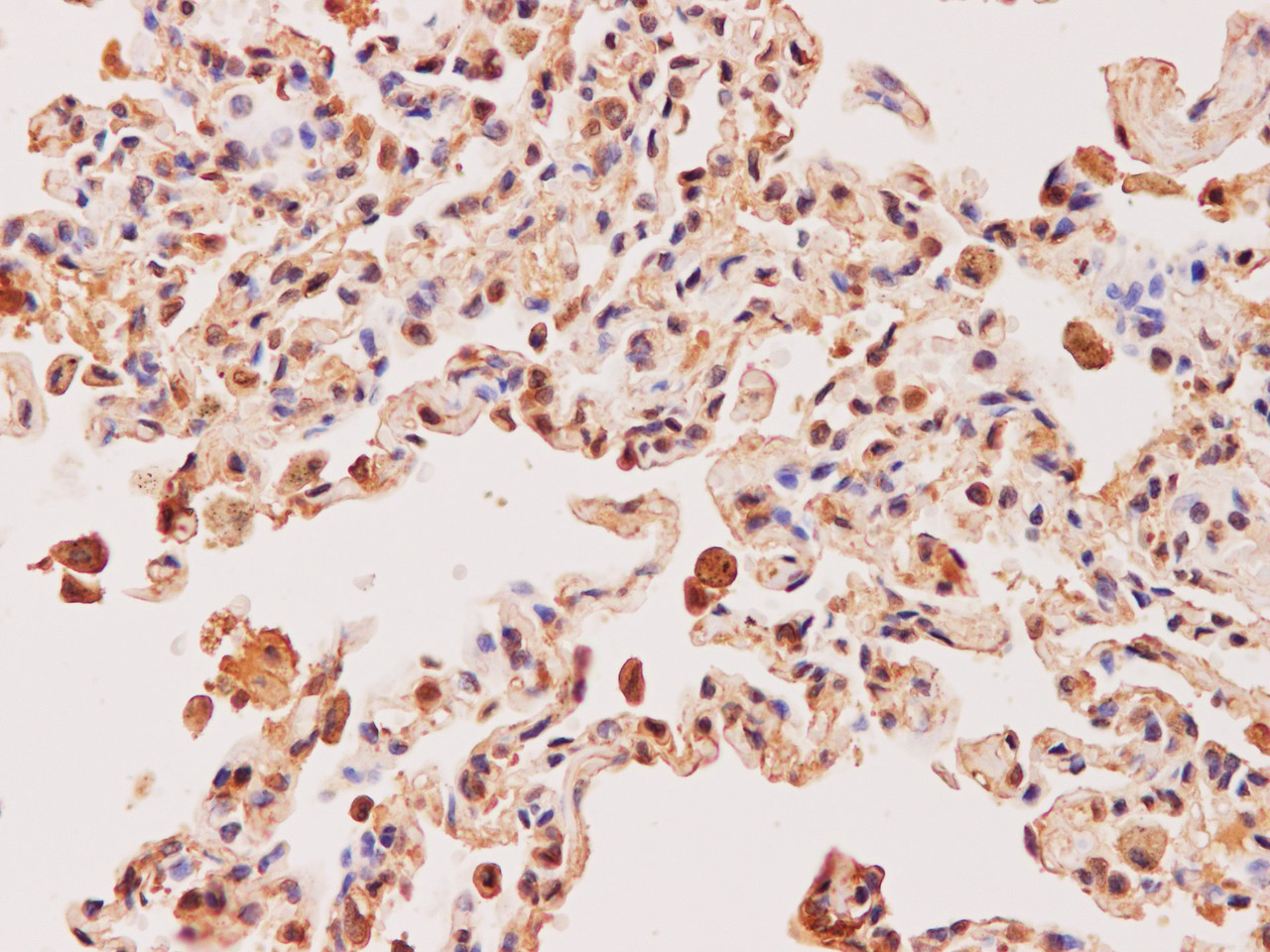 Immunohistochemistry of paraffin-embedded Human lung using EEF2 Polyclonal Antibody at dilution of 1:200