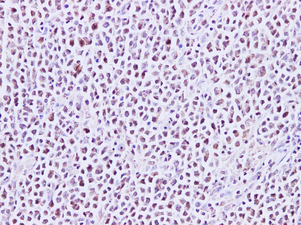 Immunohistochemistry of paraffin-embedded Human lymph node using MEF-2C Polyclonal Antibody at dilution of 1:200