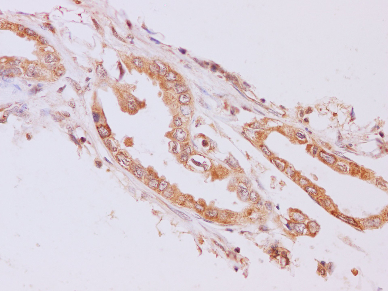 Immunohistochemistry of paraffin-embedded Humanpancreas cancer using RAB5A Polyclonal Antibody at dilution of 1:200