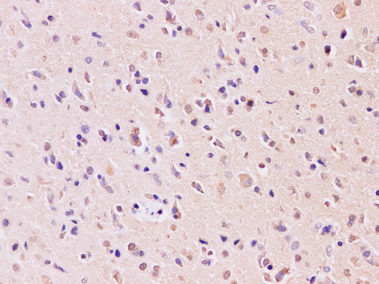 Immunohistochemistry of paraffin-embedded human gliomas using RAB5A Polyclonal Antibody at dilution of 1:200