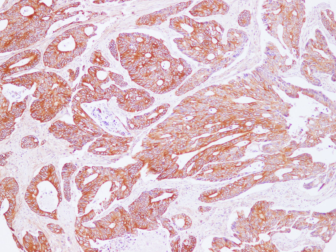 Immunohistochemistry of paraffin-embedded Human carcinoma of Colon using POSTN Polyclonal Antibody at dilution of 1:100(100×)