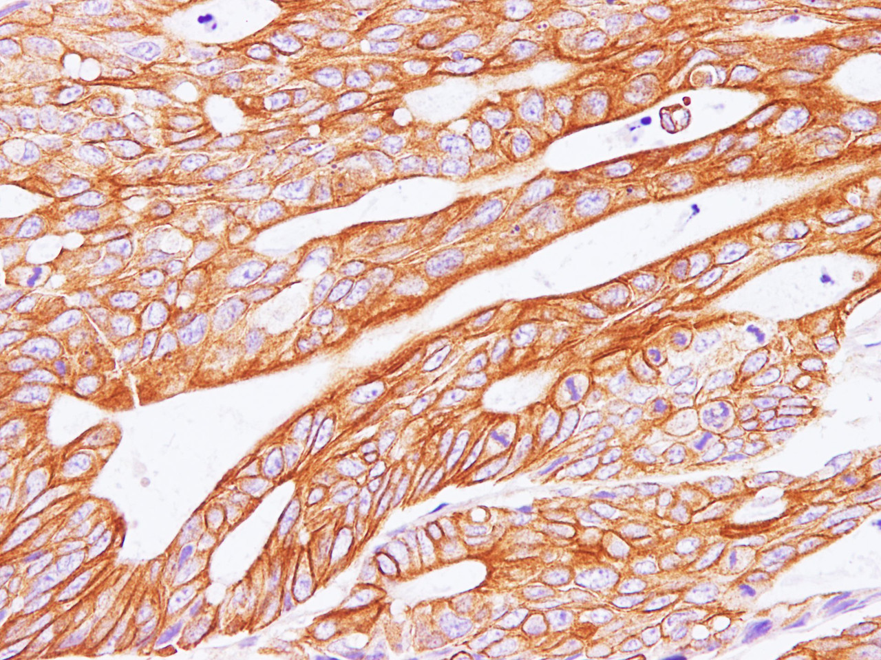 Immunohistochemistry of paraffin-embedded Human carcinoma of Colon  using POSTN Polyclonal Antibody at dilution of 1:100(400×)
