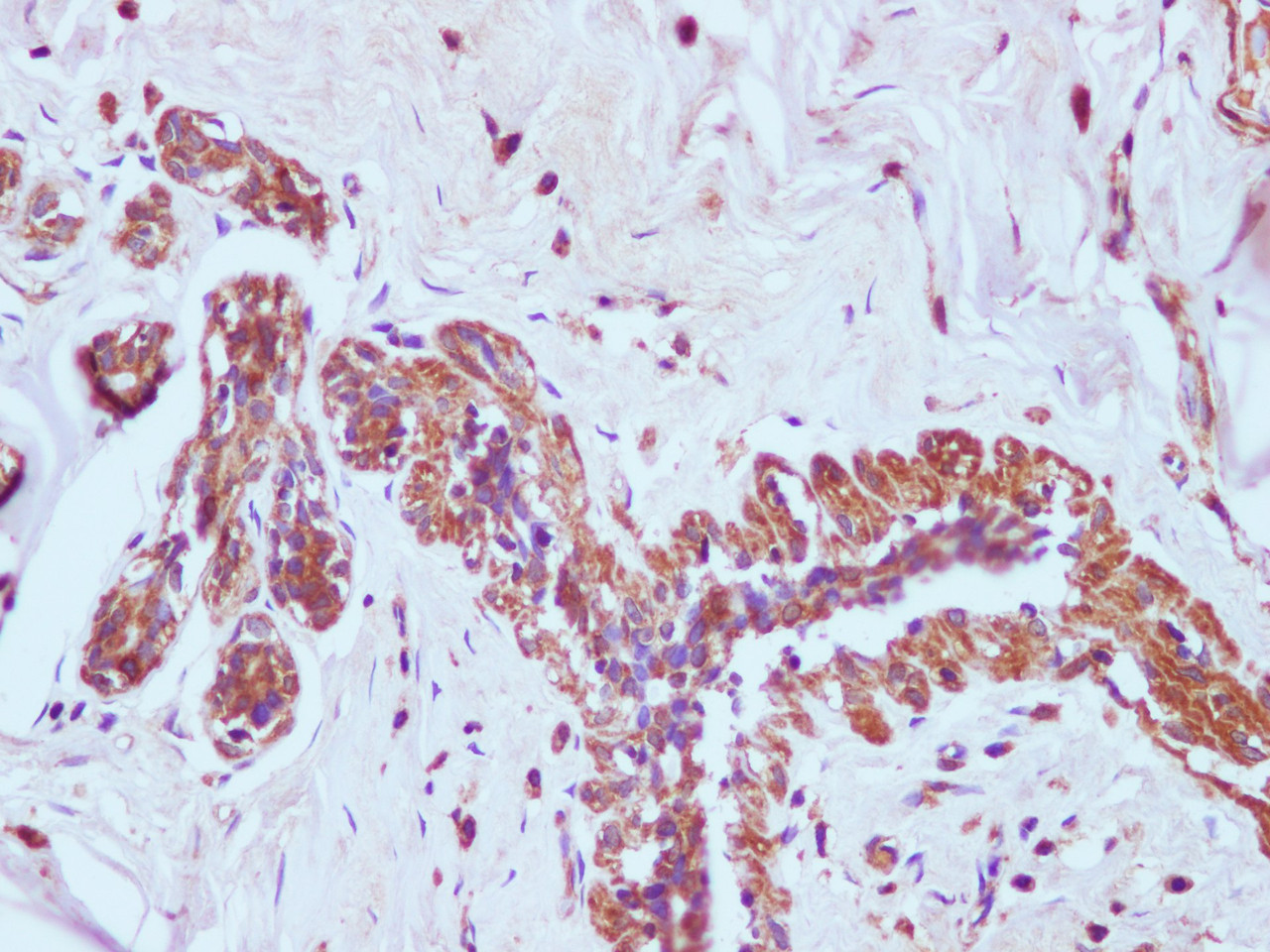 Immunohistochemistry of paraffin-embedded Human breast  using EGFR Polyclonal Antibody at dilution of 1:100