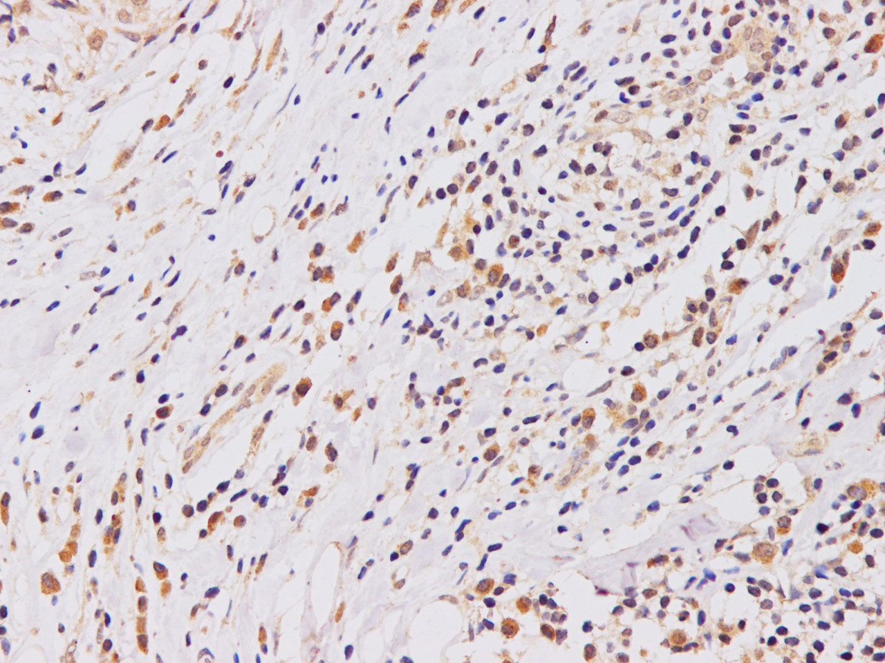 Immunohistochemistry of paraffin-embedded Human breast cancer using PTEN Polyclonal Antibody at dilution of 1:100