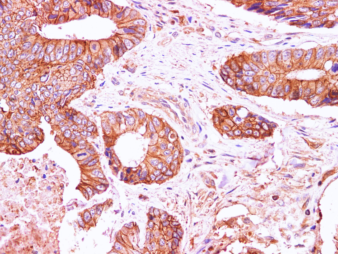 Immunohistochemistry of paraffin-embedded Human carcinoma of Colon using E-Cadherin Polyclonal Antibody at dilution of 1:100