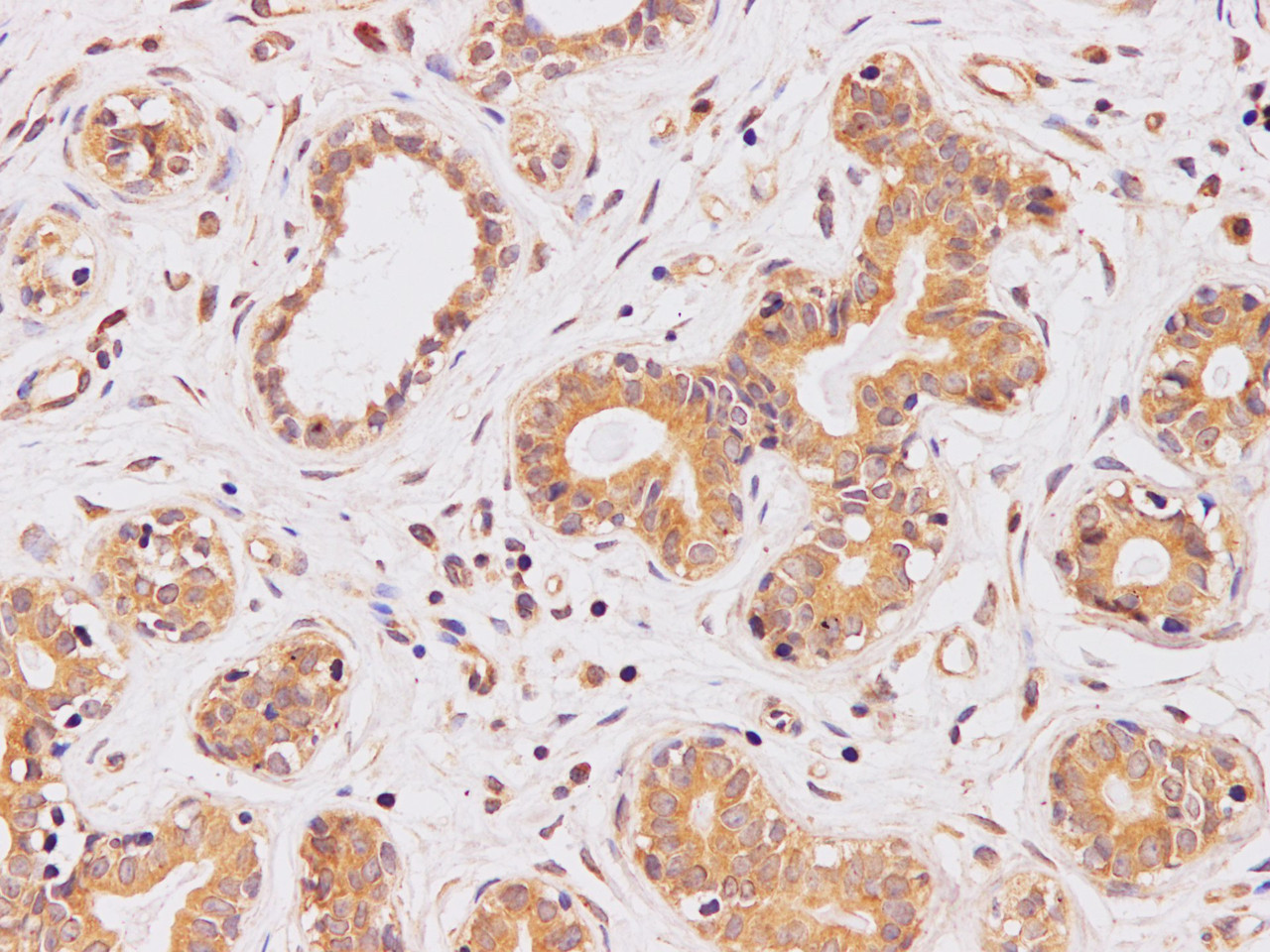 Immunohistochemistry of paraffin-embedded Human breast using PI 3 kinase p110 alpha Polyclonal Antibody at dilution of 1:100