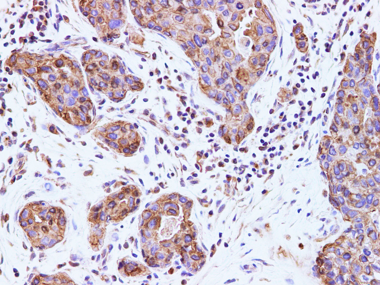 Immunohistochemistry of paraffin-embedded Human breast cancer  using CK-7 Polyclonal Antibody at dilution of 1:100