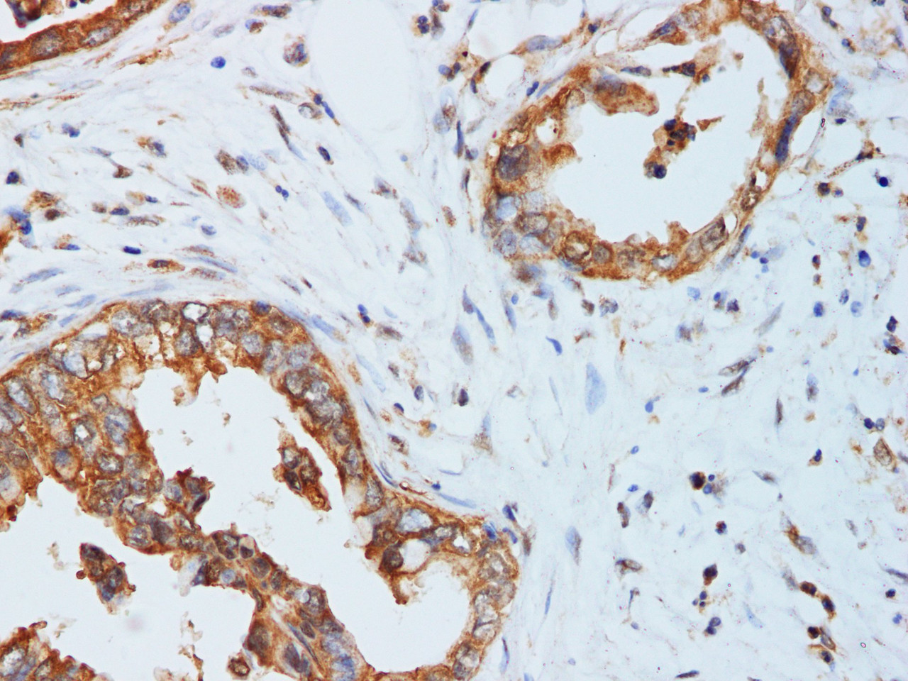 Immunohistochemistry of paraffin-embedded Pancreatic cancer using KLK10 Polyclonal Antibody at dilution of 1:200