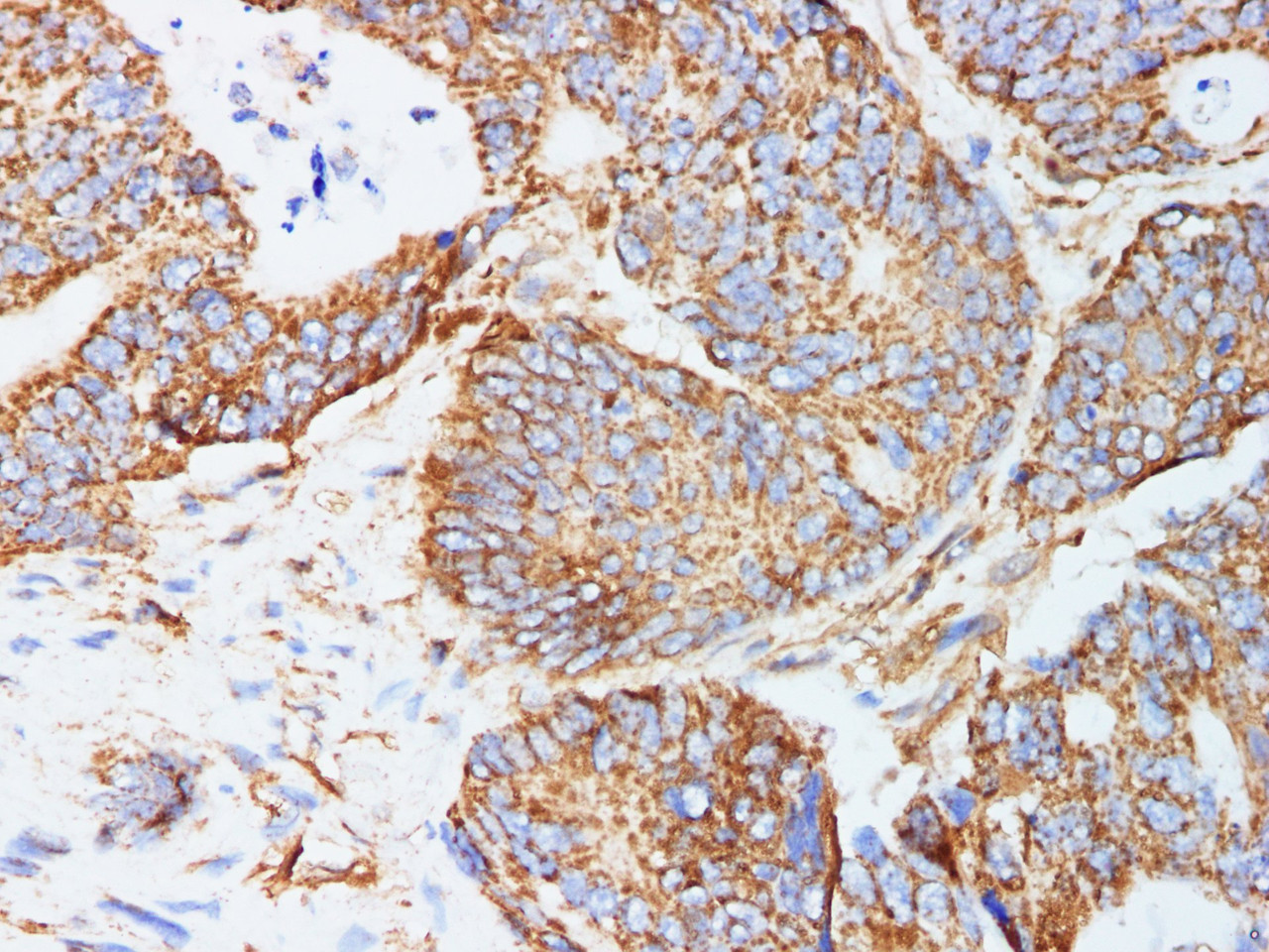 Immunohistochemistry of paraffin-embedded Human colorectal cancer using KLK6 Polyclonal Antibody at dilution of 1:200