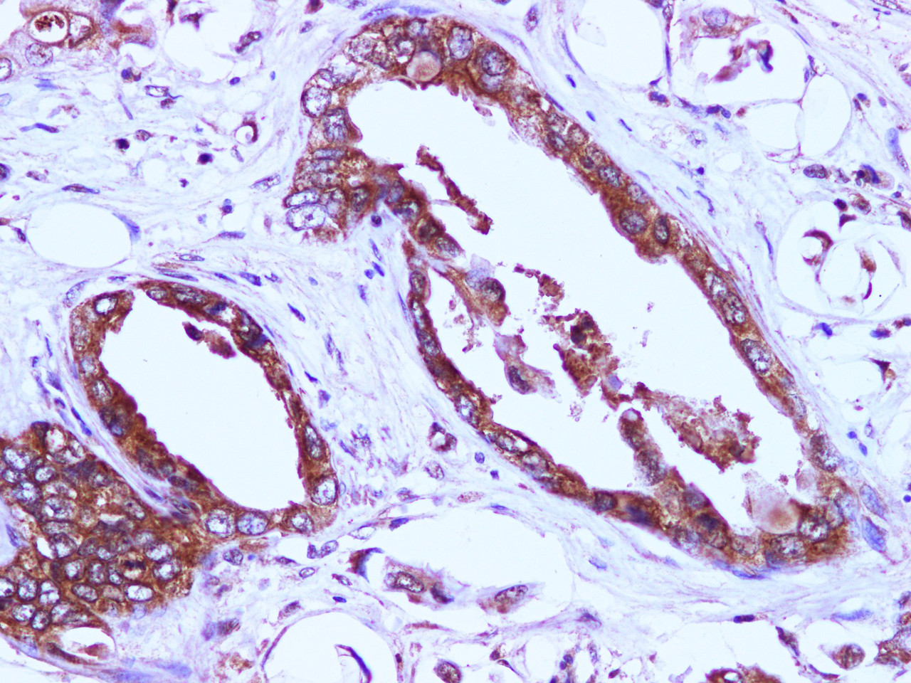 Immunohistochemistry of paraffin-embedded Human pancreatic cancer using EIF4EBP1 Polyclonal Antibody at dilution of 1:100
