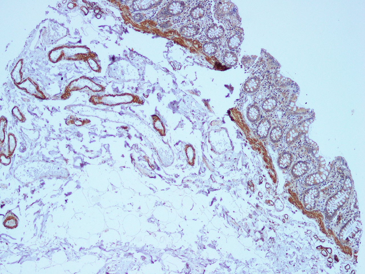 Immunohistochemistry of paraffin-embedded Human colon using COL1A1 Polyclonal Antibody at dilution of 1:100(100×)