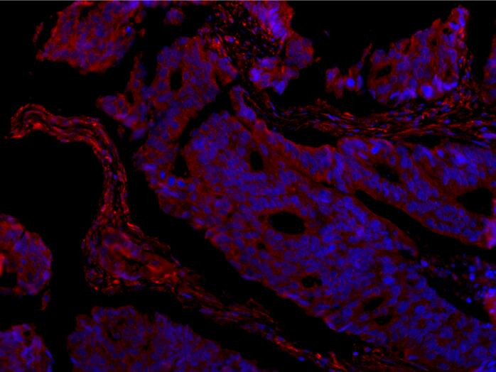 Immunofluorescence analysis of paraffin-embedded human colon cancer using COL1A1 Antibody at dilution of 1:150.