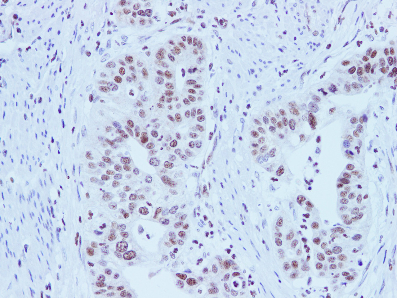 Immunohistochemistry of paraffin-embedded Human stomach cancer using HMGB1 Polyclonal Antibody at dilution of 1:100