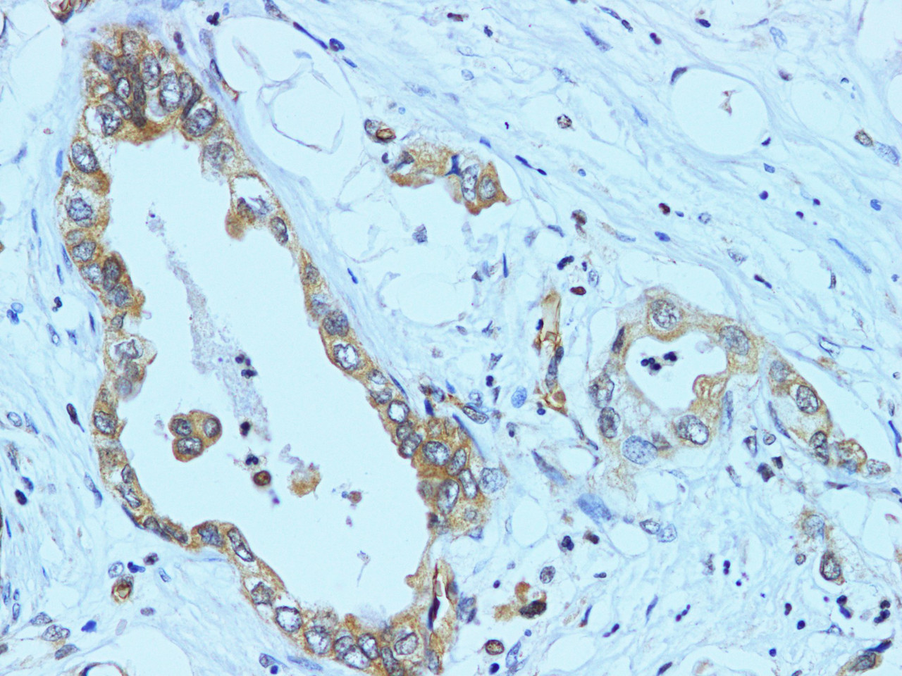 Immunohistochemistry of paraffin-embedded Human pancreatic cancer using NF2 Polyclonal Antibody at dilution of 1:100(400×)