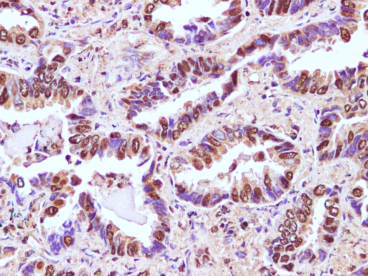 Immunohistochemistry of paraffin-embedded Human lung cancer using RBM3 Polyclonal Antibody at dilution of 1:100