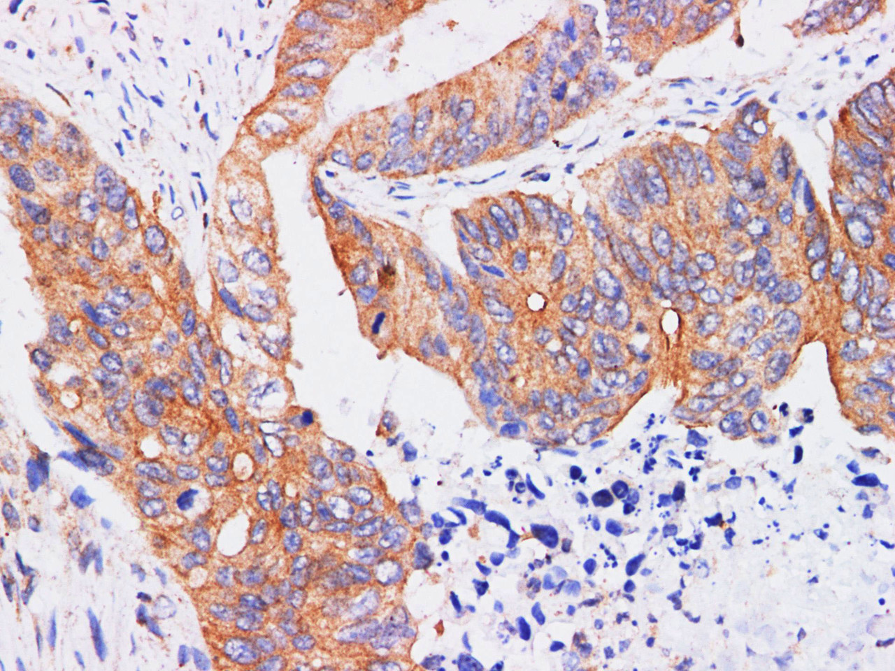 Immunohistochemistry of paraffin-embedded Human colon using REG4 Polyclonl Antibody at dilution of 1:200.