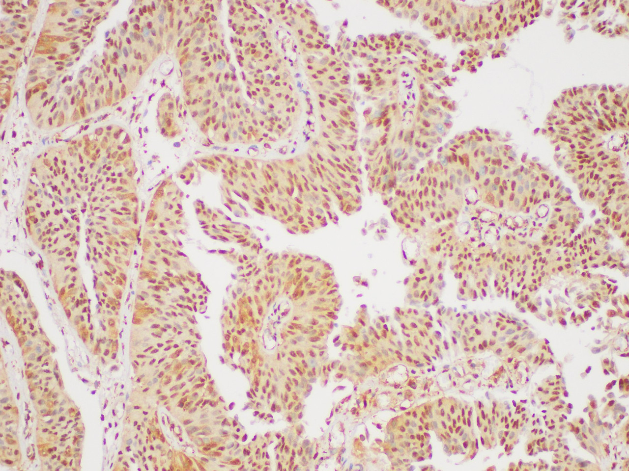 Immunohistochemistry of paraffin-embedded Human bladder cancer using GAPDH Polyclonal Antibody at dilution of 1:400
