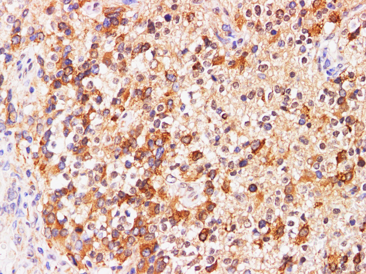 Immunohistochemistry of paraffin-embedded Human glioma using PRL Polyclonal Antibody at dilution of 1:200