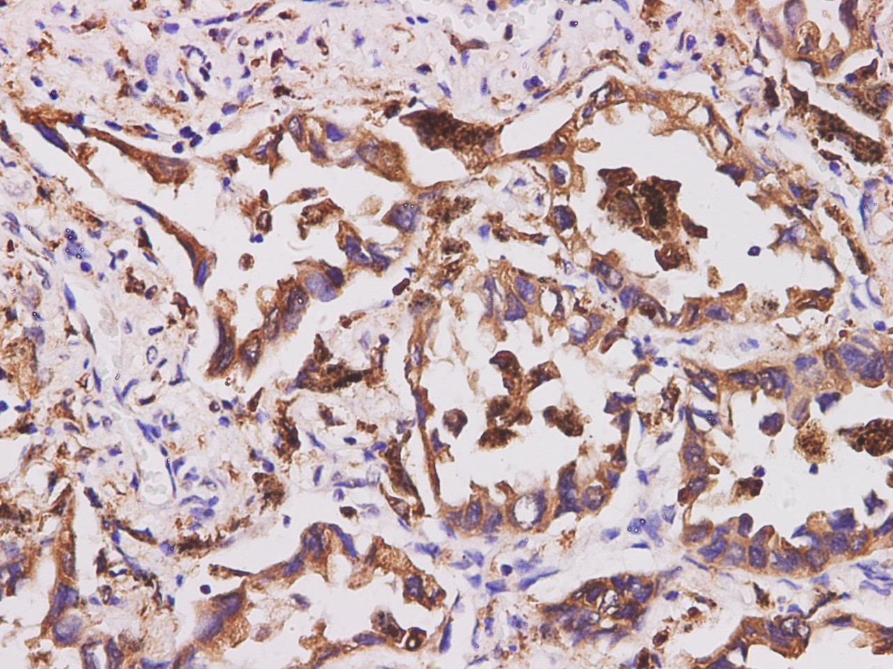 Immunohistochemistry of paraffin-embedded Human lung cancer  using CD74 Polyclonal Antibody at dilution of 1:200