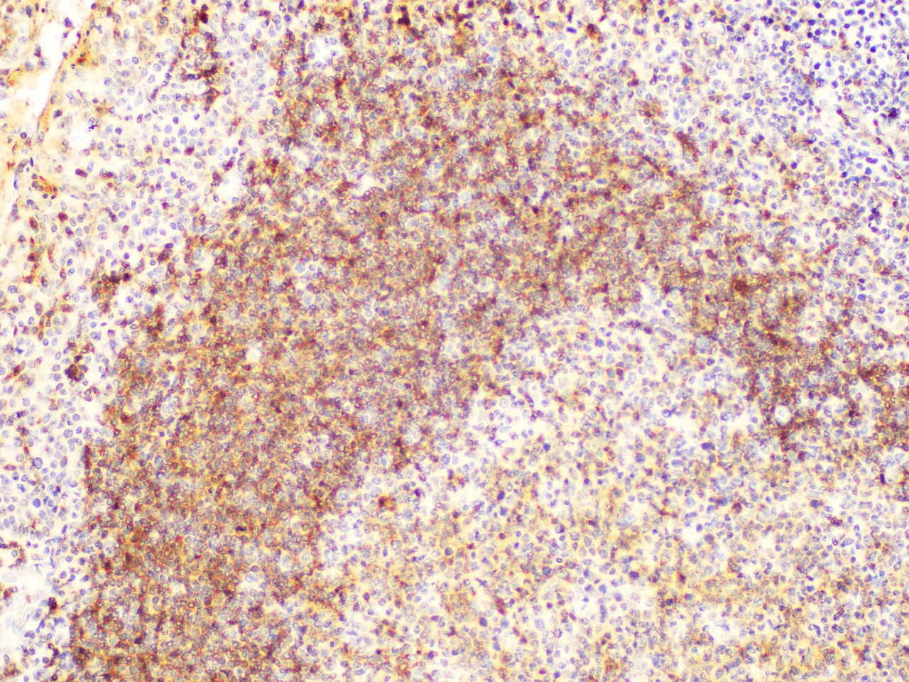 Immunohistochemistry of paraffin-embedded Human tonsil using CD22 Polycloanl Antibody at dilution of 1:200