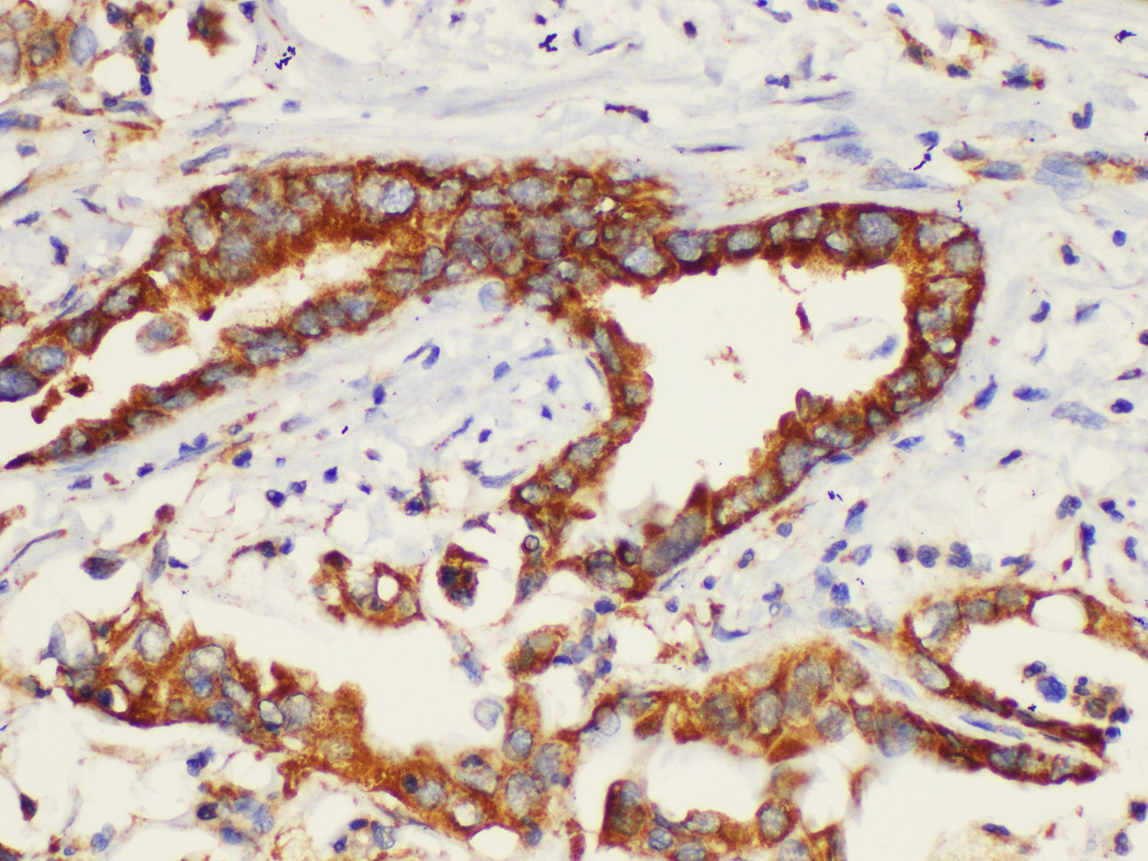 Immunohistochemistry of paraffin-embedded Human pancreatic cancer using K1KB3 Ployclonal Antibody at dilution of 1:200.