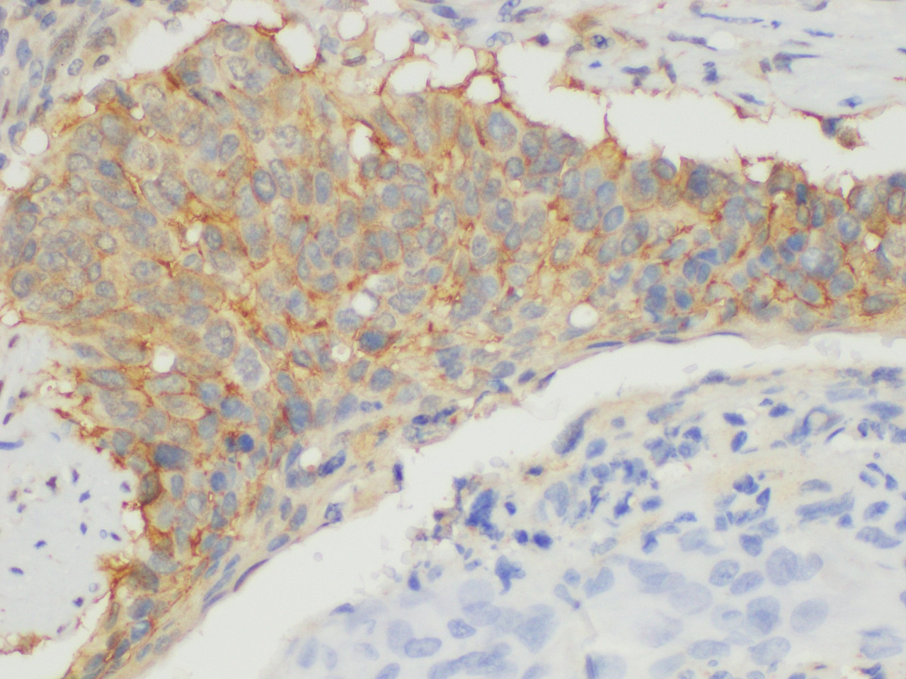 Immunohistochemistry of paraffin-embedded Human lung cancer using CD109 Ployclonal Antibody at dilution of 1:100.