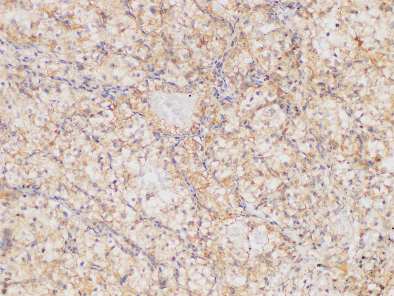 Immunohistochemistry of paraffin-embedded Human clear cell carcinoma of kidney using MMP2 Polycloanl Antibody at dilution of 1:100