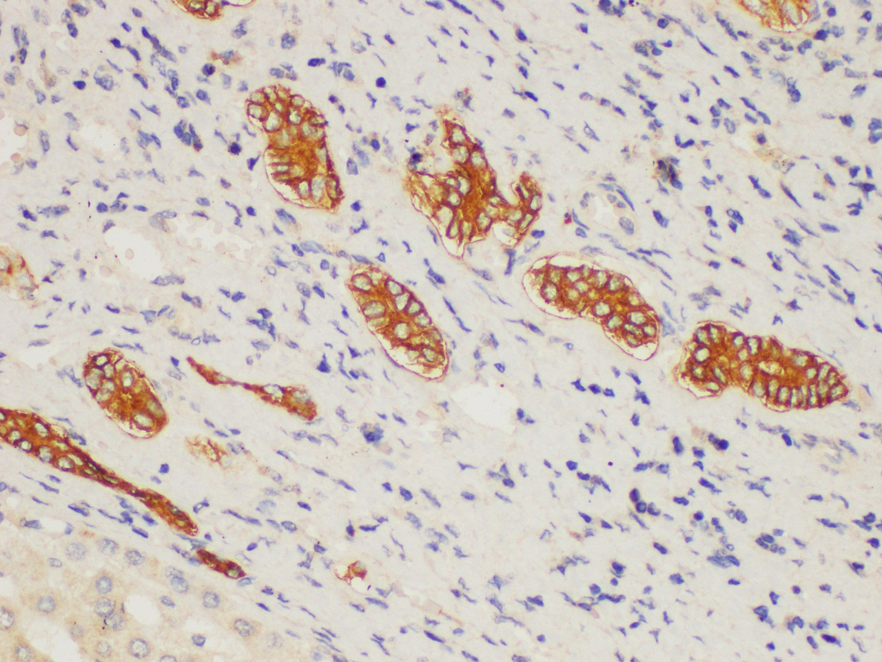 Immunohistochemistry of paraffin-embedded Human liver cancer using MMP9 Polycloanl Antibody at dilution of 1:50