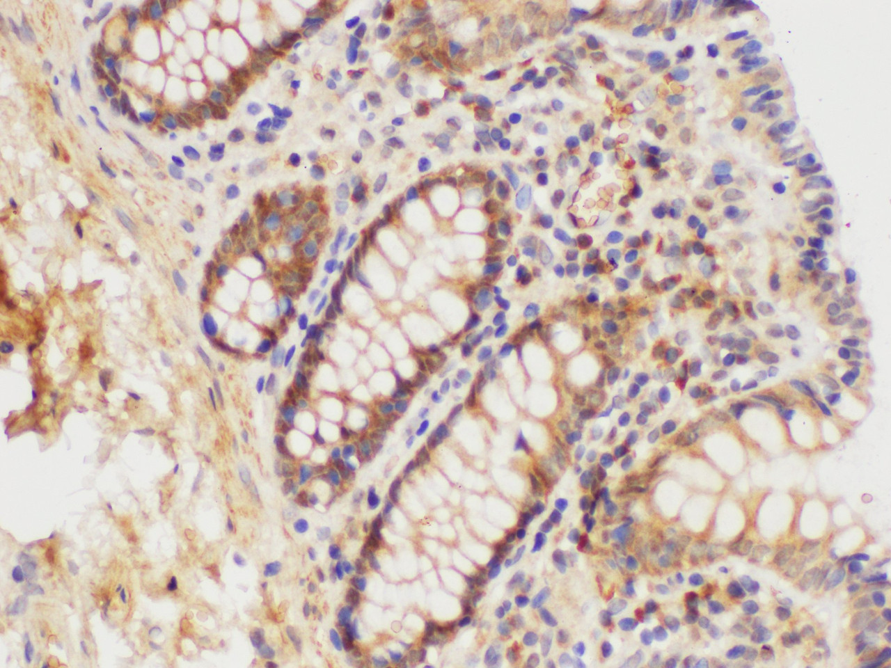 Immunohistochemistry of paraffin-embedded Human colon using S100A6 Polycloanl Antibody at dilution of 1:100