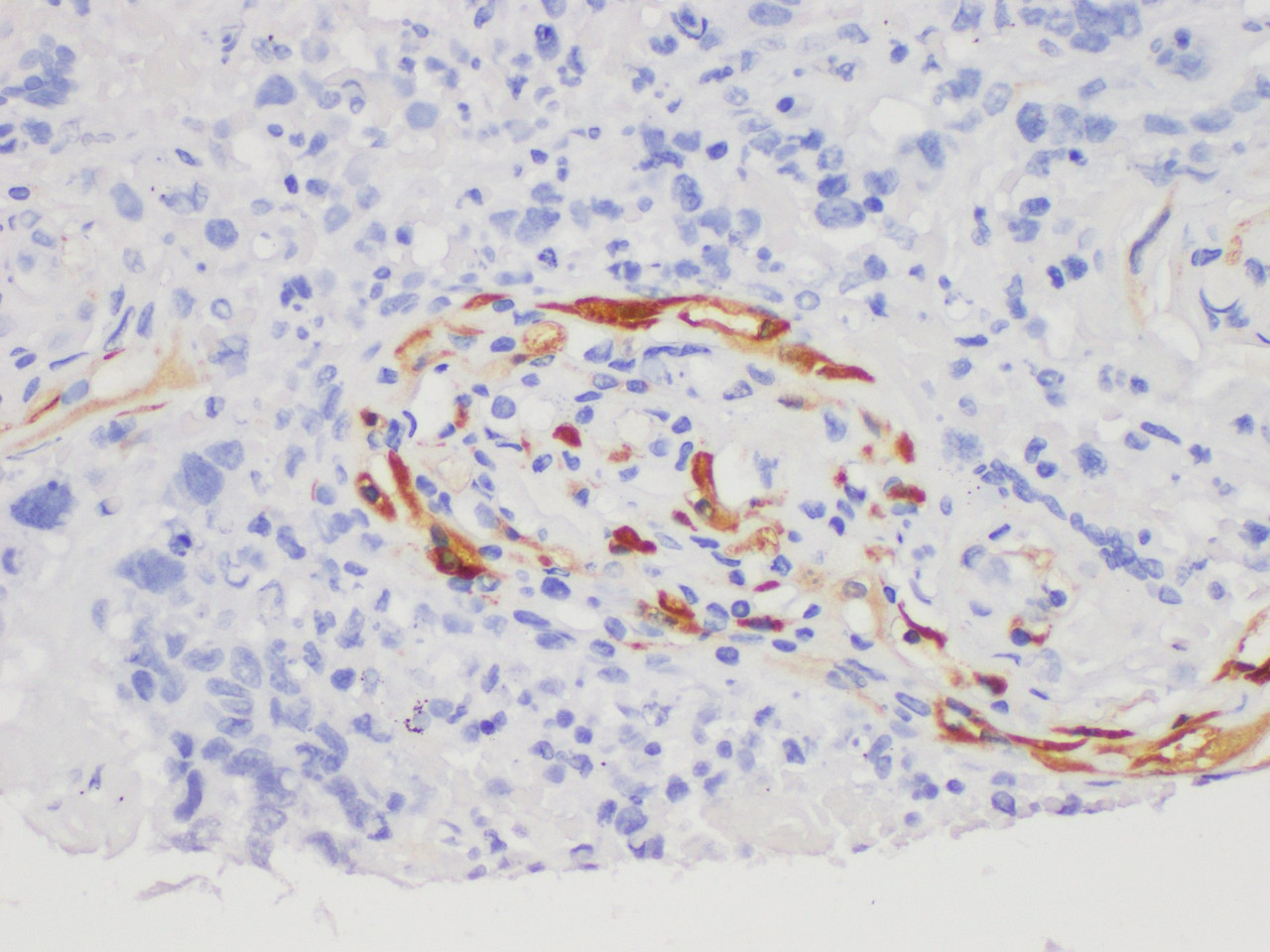 Immunohistochemistry of paraffin-embedded Human lung cancer using S100A7 Polycloanl Antibody at dilution of 1:200