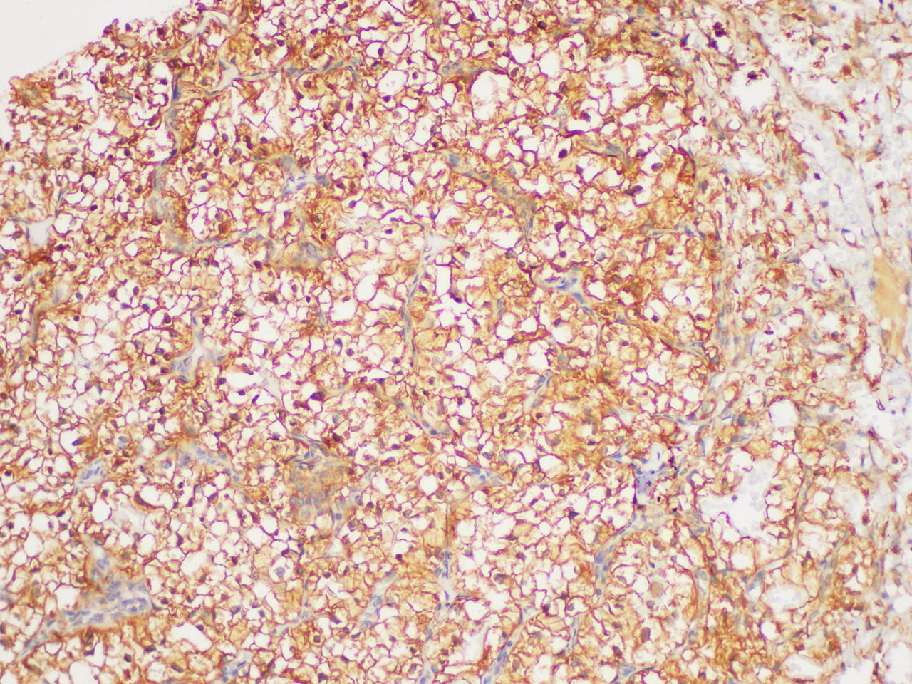 Immunohistochemistry of paraffin-embedded Human clear cell carcinoma of kidney using TGFB2 Polycloanl Antibody at dilution of 1:200
