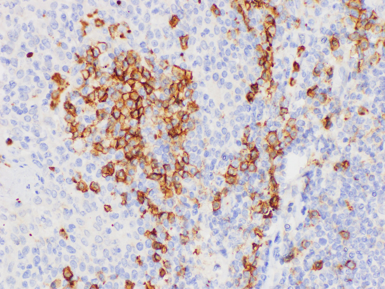 Immunohistochemistry of paraffin-embedded Human tonsil using CD38 Polycloanl Antibody at dilution of 1:200