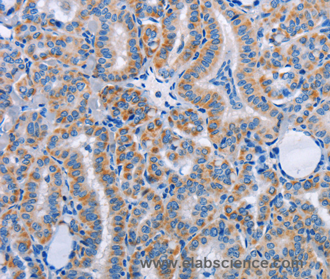 Immunohistochemistry of paraffin-embedded Human thyroid cancer tissue using FN1 Polyclonal Antibody at dilution 1:50