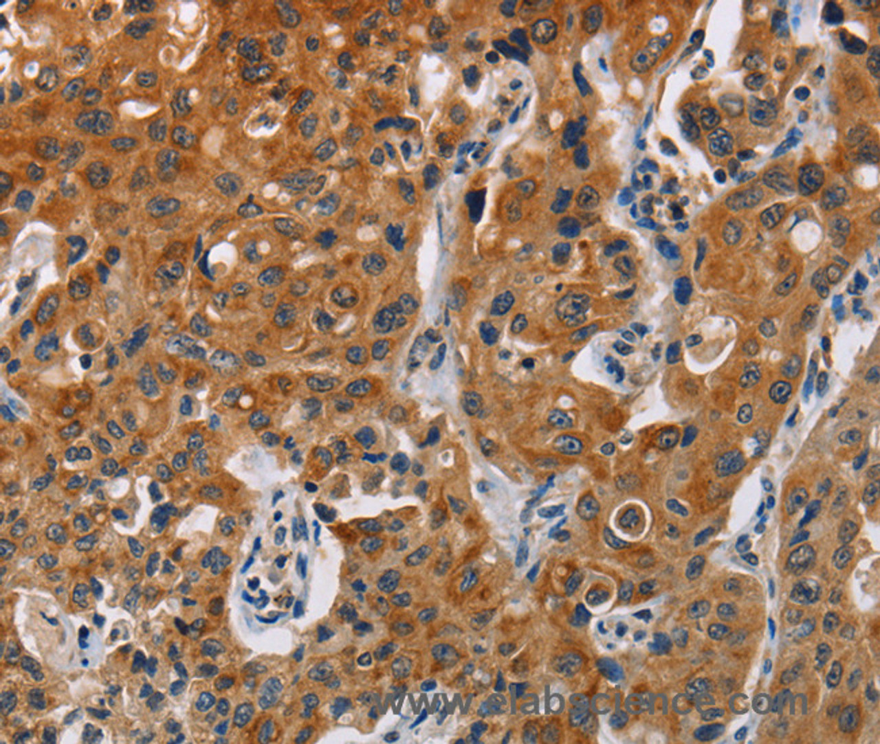 Immunohistochemistry of paraffin-embedded Human lung cancer tissue using CK-13 Polyclonal Antibody at dilution 1:50
