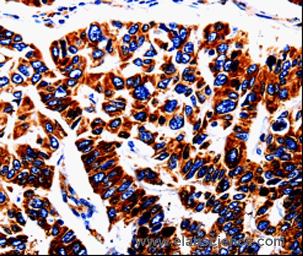 Immunohistochemistry of paraffin-embedded Human lung cancer tissue using UTS2 Polyclonal Antibody at dilution 1:50