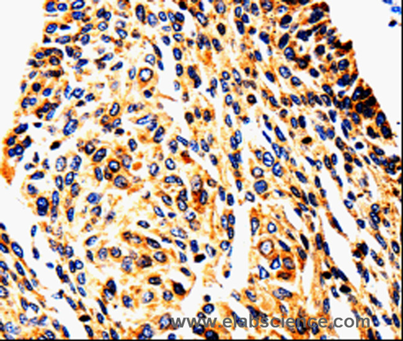 Immunohistochemistry of paraffin-embedded Human cervical cancer tissue using UTS2 Polyclonal Antibody at dilution 1:50