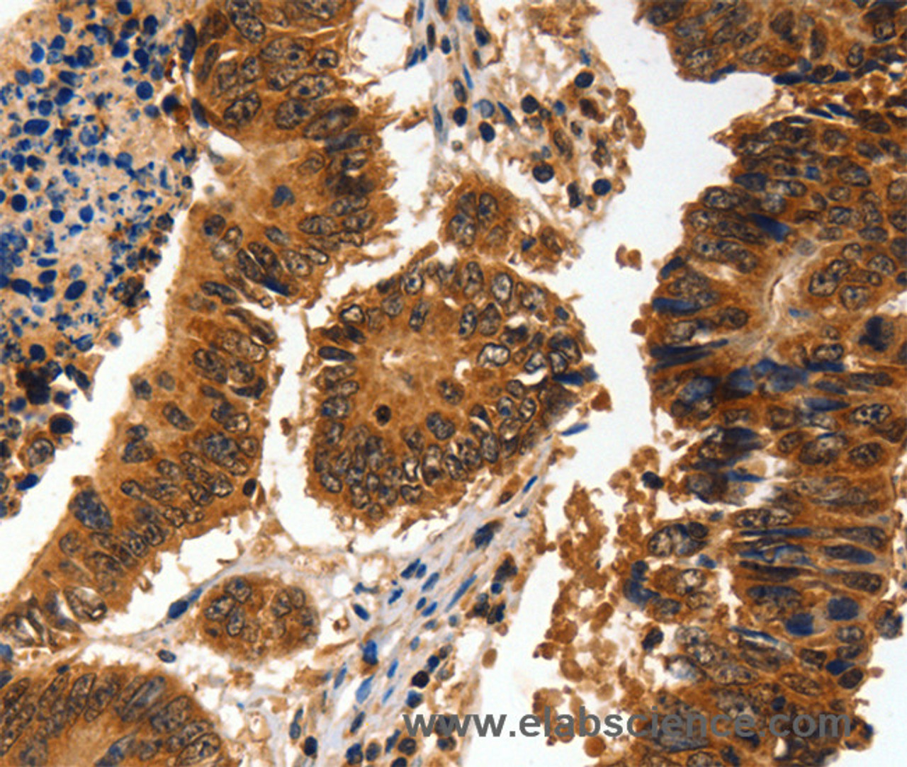 Immunohistochemistry of paraffin-embedded Human colon cancer using ADAP1 Polyclonal Antibody at dilution of 1:60