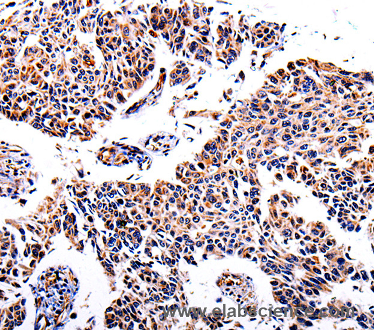 Immunohistochemistry of paraffin-embedded Human lung cancer  using AKR1B1 Polyclonal Antibody at dilution of 1:40
