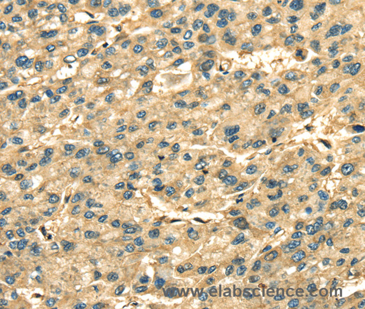 Immunohistochemistry of paraffin-embedded Human liver cancer using ANXA2 Polyclonal Antibody at dilution of 1:35