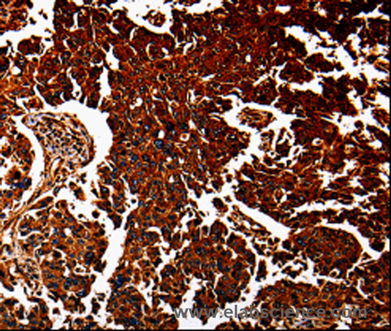 Immunohistochemistry of paraffin-embedded Human lung cancer tissue using ANXA7 Polyclonal Antibody at dilution 1:40