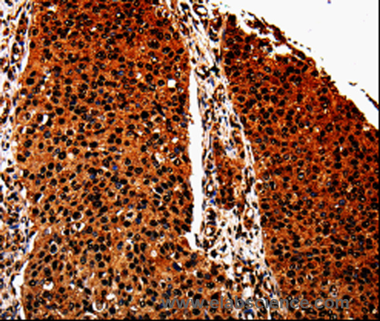 Immunohistochemistry of paraffin-embedded Human renal cancer tissue using ANXA7 Polyclonal Antibody at dilution 1:40