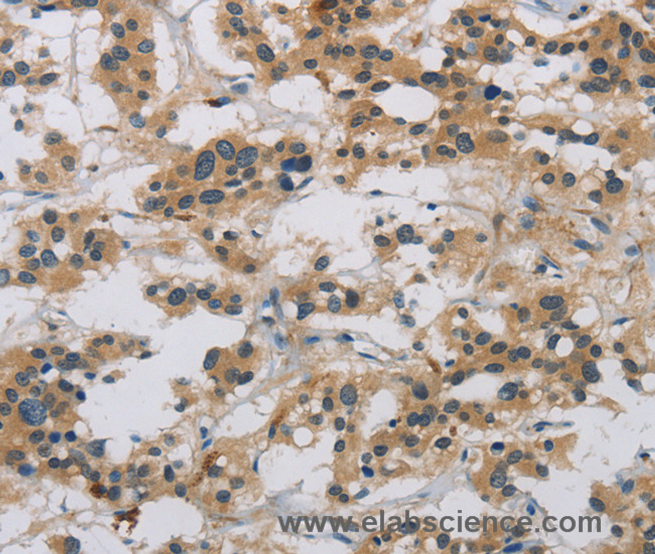 Immunohistochemistry of paraffin-embedded Human thyroid cancer tissue using CASP9 Polyclonal Antibody at dilution 1:60