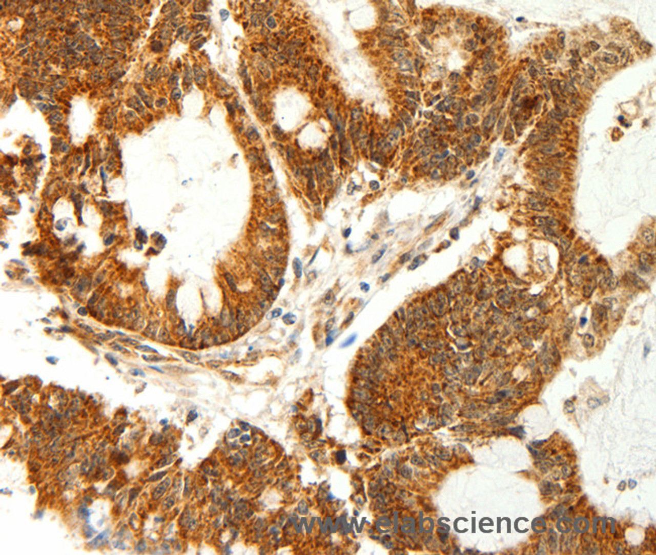 Immunohistochemistry of paraffin-embedded Human colon cancer using COX7B Polyclonal Antibody at dilution of 1:60